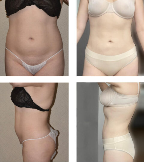 Before and after photos of a woman's tummy tuck transformation, showcasing the impact of liposuction.