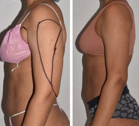 Tummy tuck and liposuction before and after.