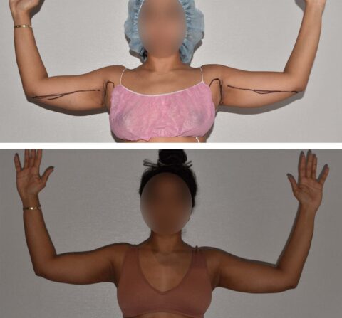 Before and after photos of a woman's tummy tuck with liposuction.