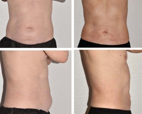 Liposuction before and after, including tummy tuck.