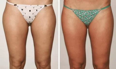 Liposuction before and after photos of a woman's bikini.