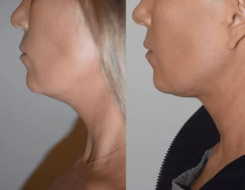 Liposuction Before and After - A woman's neck transformation.