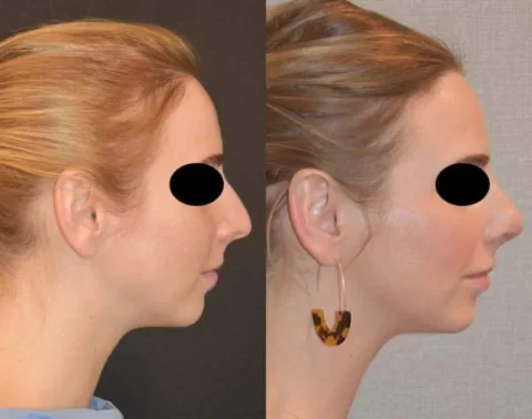 Rhinoplasty Before and After Photo Gallery showcasing a woman's transformation.