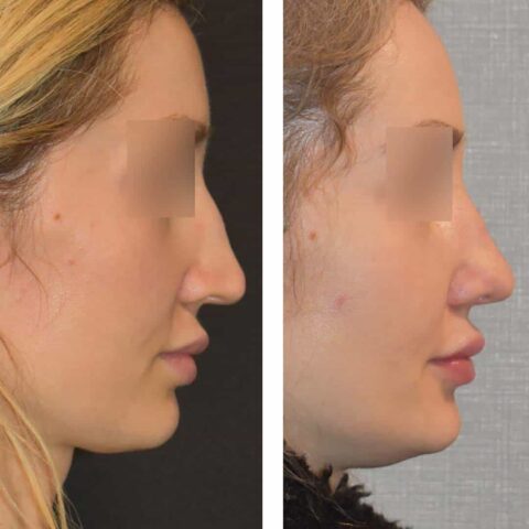 Rhinoplasty Before and After Photo Gallery