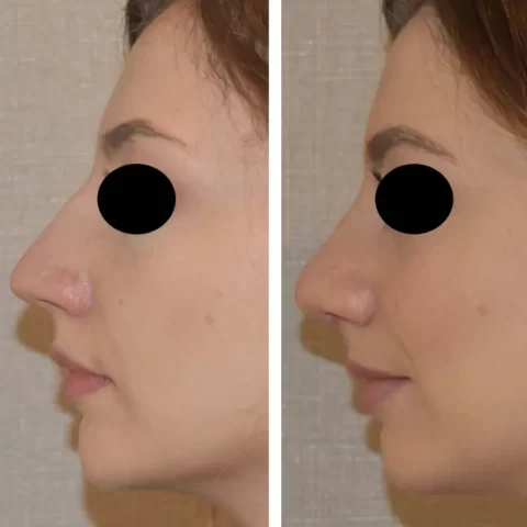 Explore the changes in a woman's nose through our Rhinoplasty Before and After Photo Gallery.