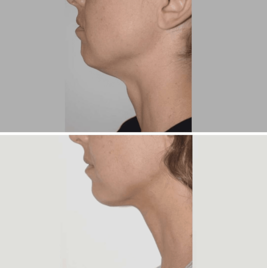 A woman's CHIN before and after liposuction.
