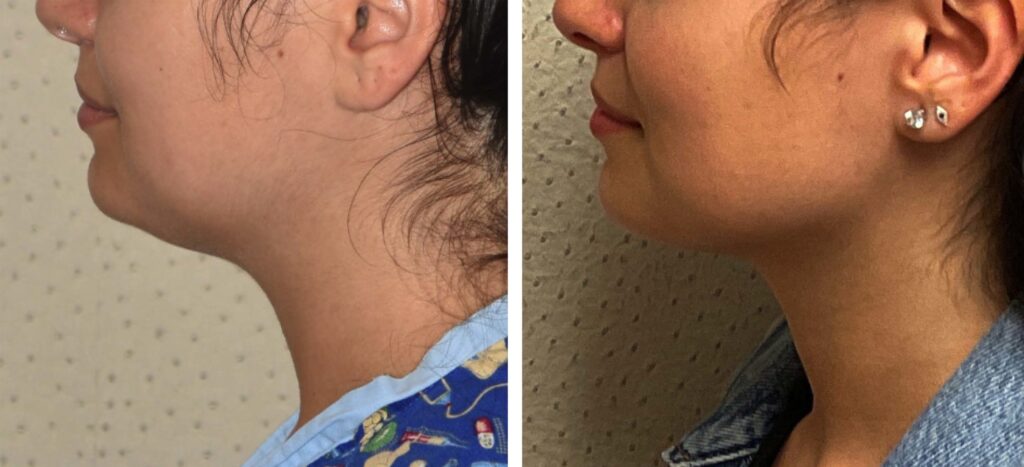 A woman's chin before and after liposuction.