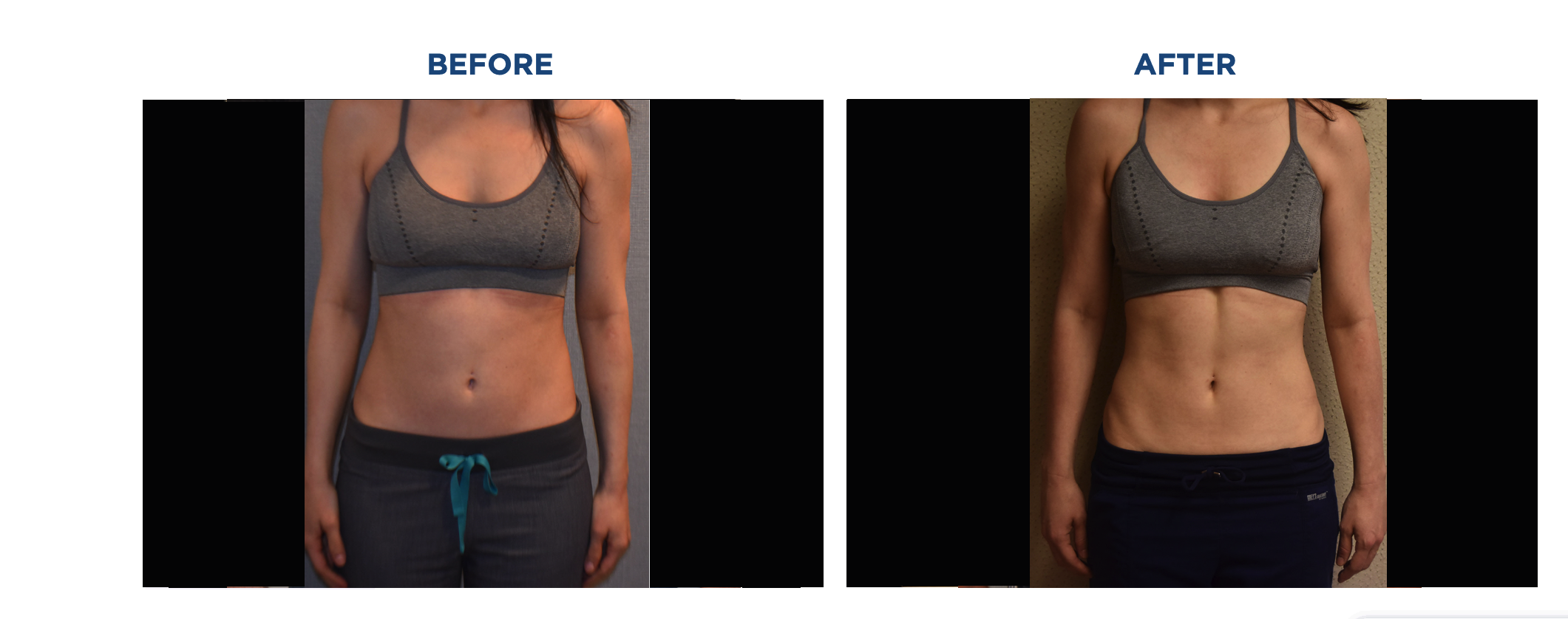 A woman's stomach before and after Emsculpt Neo treatment for liposuction.