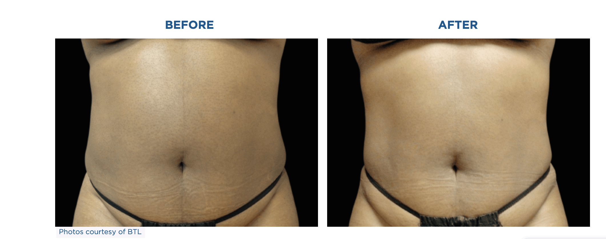 A woman's abdomen before and after undergoing Emsculpt Neo treatment for liposuction.