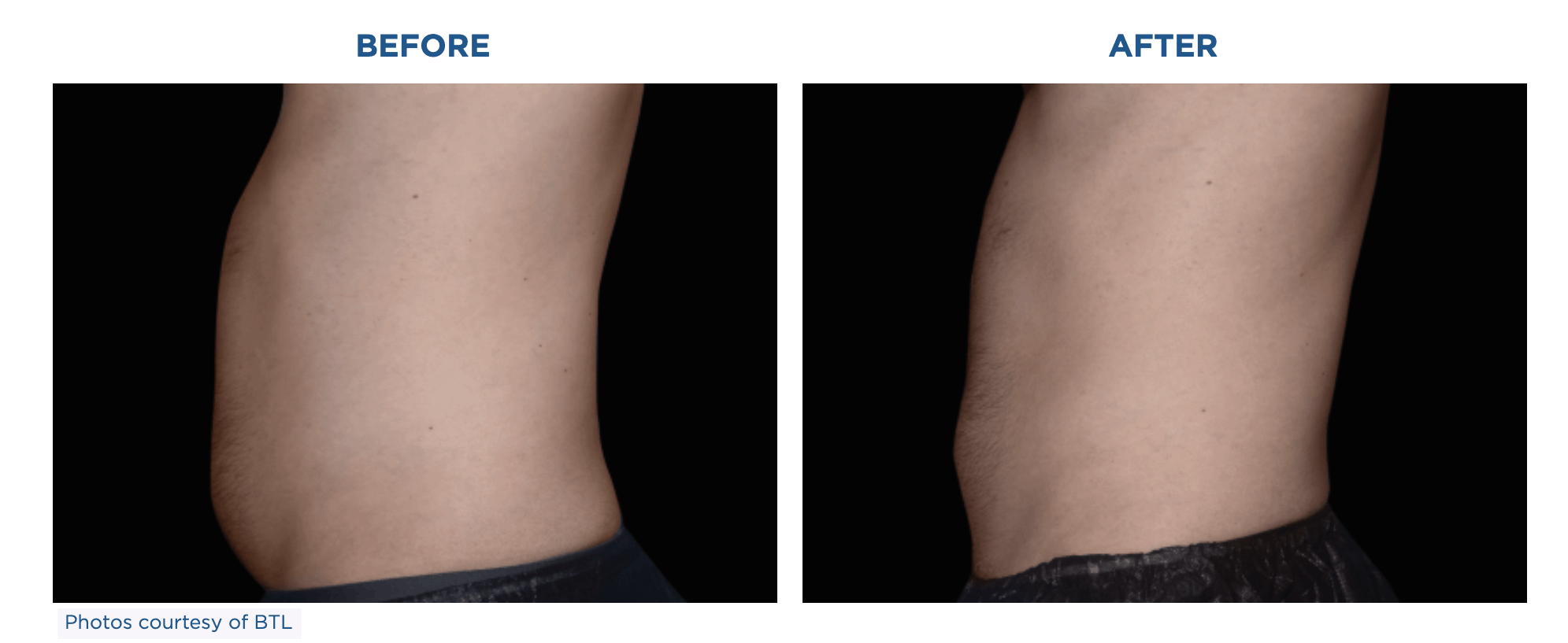 Before and after images showcasing the transformative results of Emsculpt Neo on a woman's thigh.