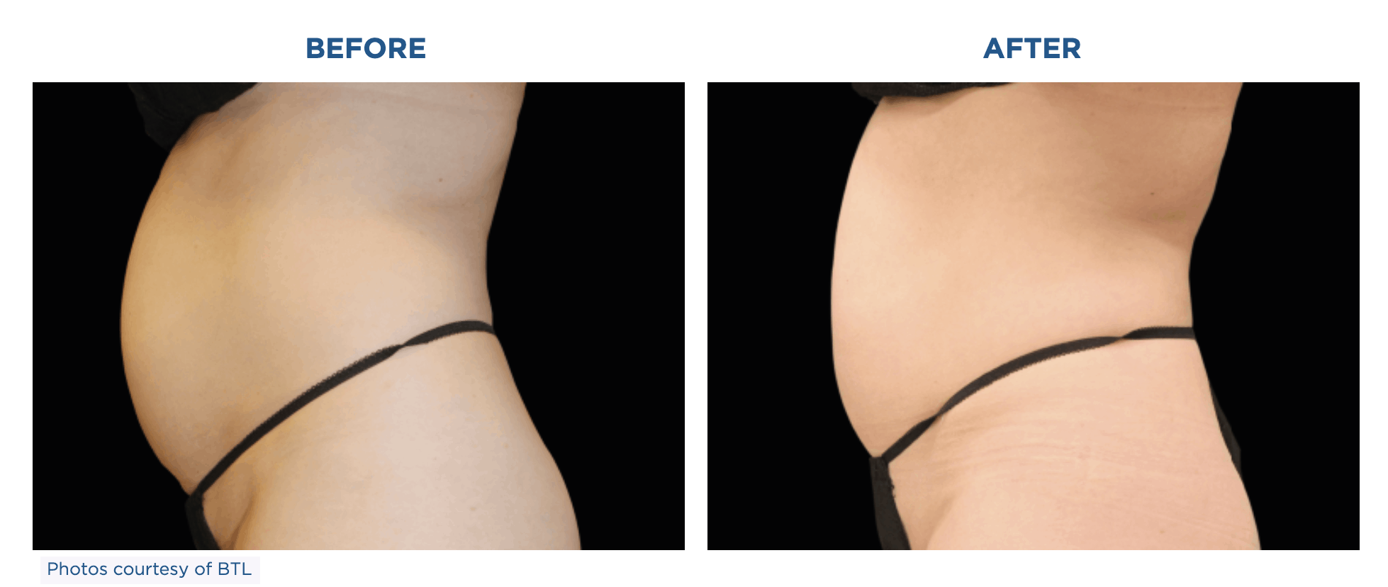 Emsculpt Neo for tummy tuck before and after results.