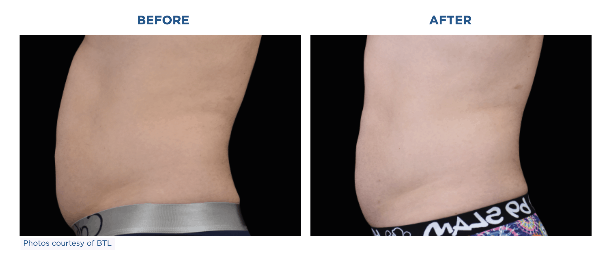 Transform your body with Emsculpt Neo - see amazing tummy tuck before and after results!