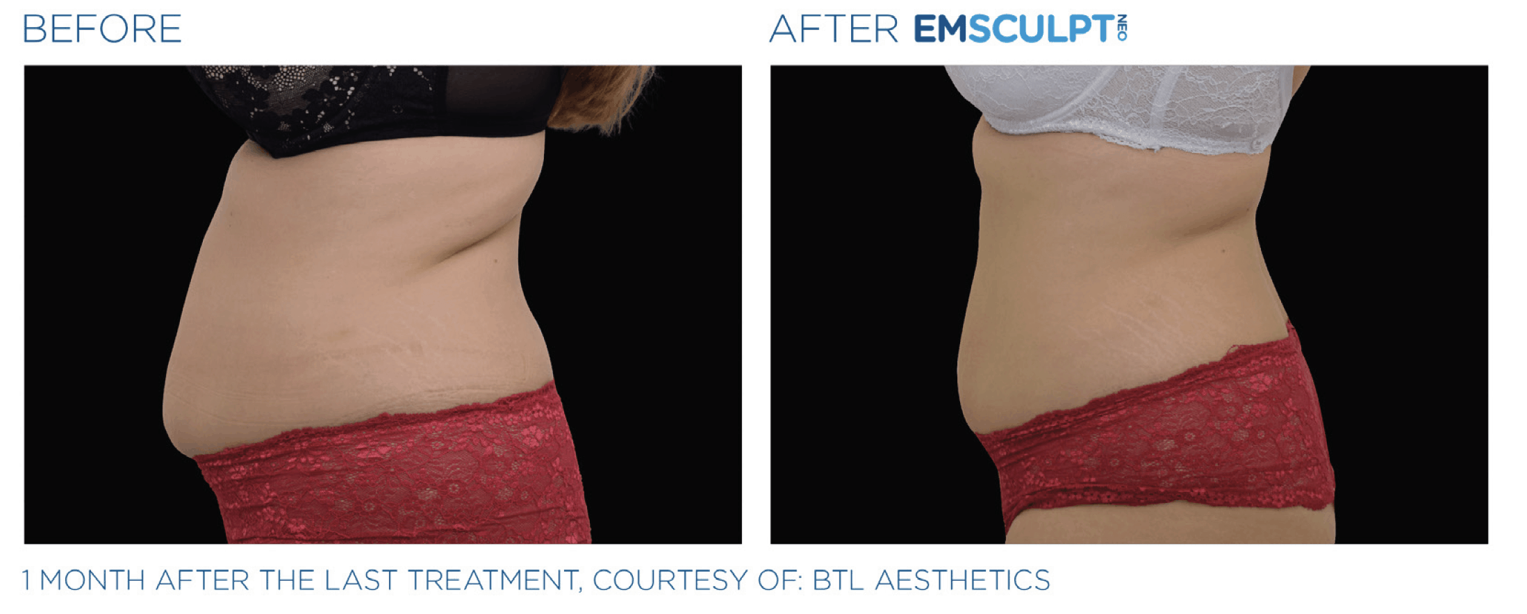 Witness the remarkable transformation of a tummy tuck before and after with the innovative Emsculpt Neo technology. Experience the incredible results achieved by this groundbreaking procedure in sculpting and toning