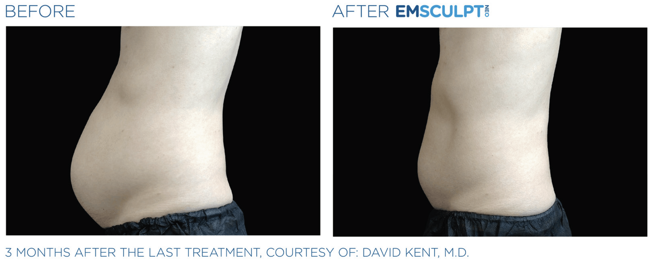 A dramatic transformation captured in a before and after photo of a tummy tuck complemented by Emsculpt Neo technology.