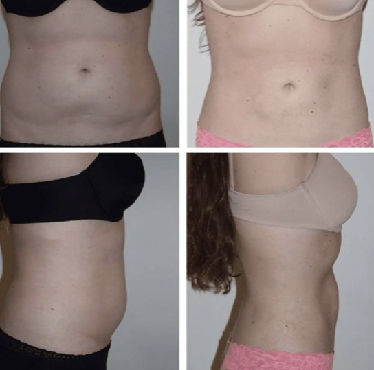 360 Lipo Without Tummy Tuck: Things You Need to Know - Salameh