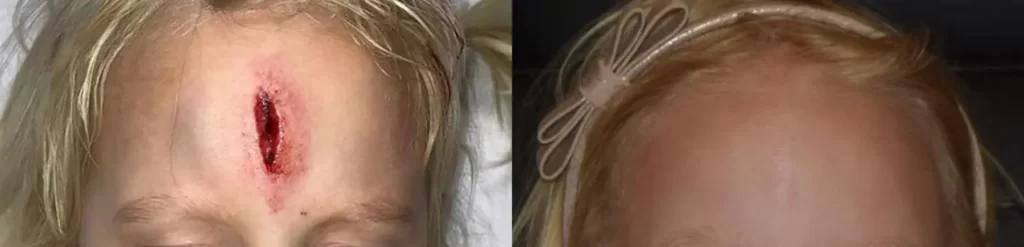 Two pictures of a woman post-Pediatric Plastic Surgery NYC, showcasing her scar on her head.