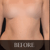 A woman's breast before and after surgery.