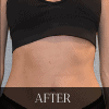 A woman's stomach before and after liposuction.