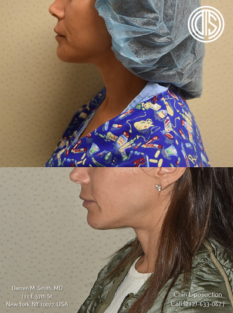 before and after portrait of a woman who had chin liposuction procedure
