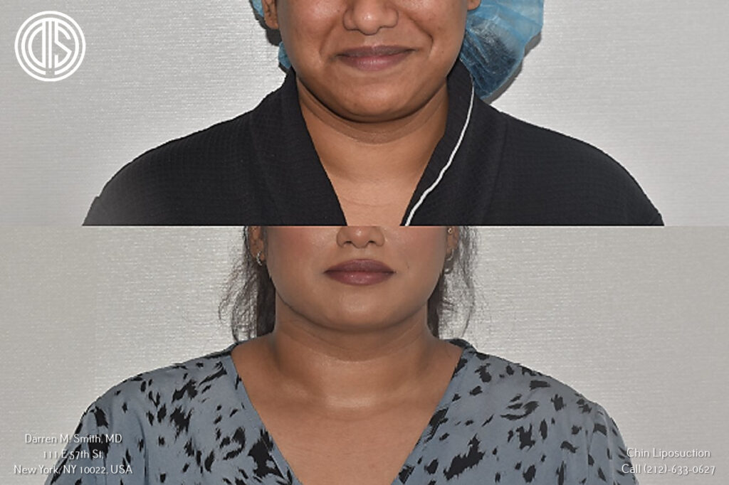 before and after portrait of a woman who had chin liposuction procedure
