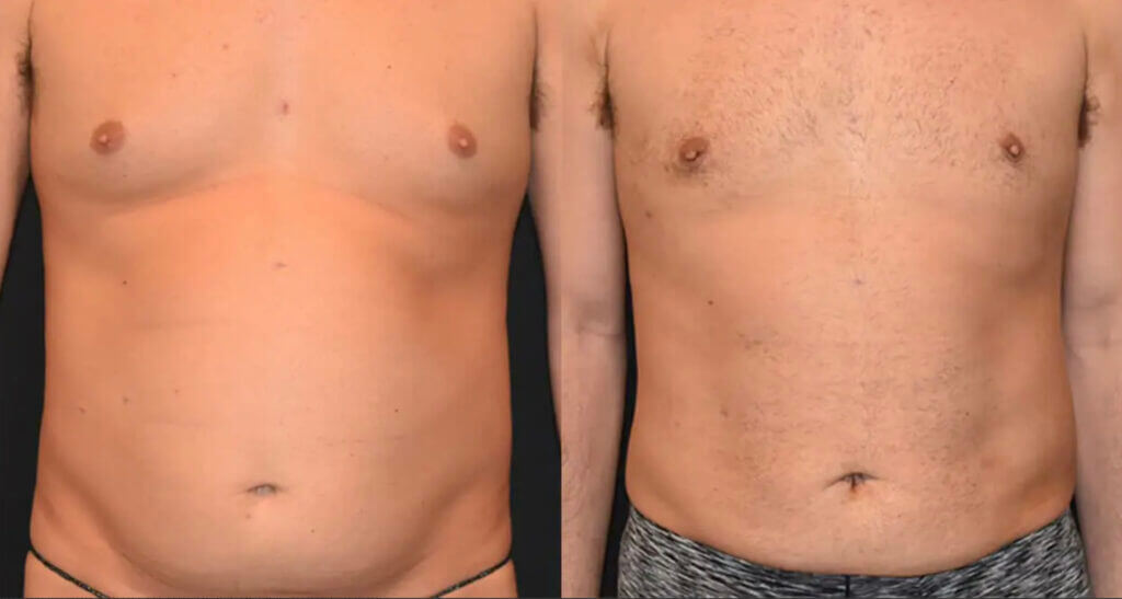 Airsculpt tummy tuck before and after.