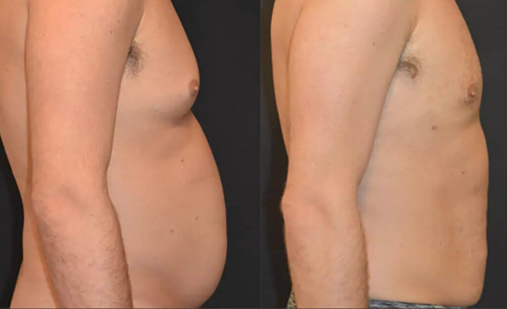 Tummy tuck with Airsculpt before and after photo.