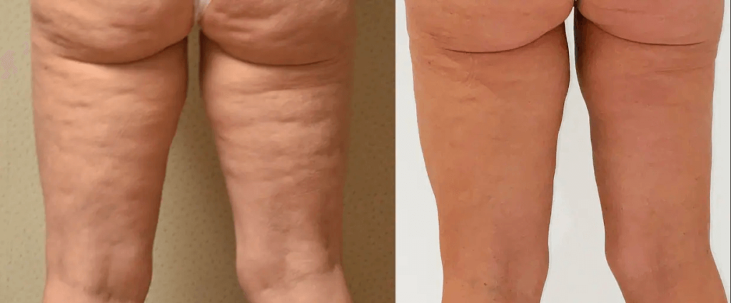 Stunning before and after pictures showcasing the transformative results of Airsculpt on a woman's legs.