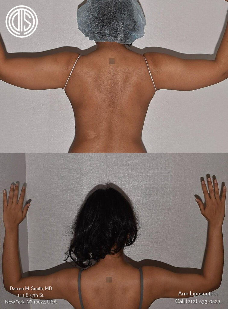 A woman's arms before and after arm liposuction, revealing a transformed silhouette.