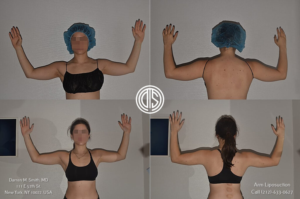 Four pictures of a woman's arms before and after arm liposuction surgery.