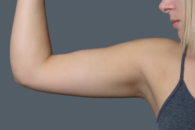 A woman proudly displaying her beautifully toned arms after undergoing brachioplasty.