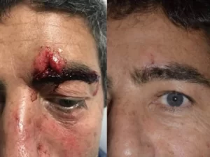 Two pictures of a man with a bruise on his face requiring Emergency Plastic Surgery.