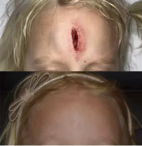 Two pictures of a little girl after emergency plastic surgery, showcasing her scar on her head.