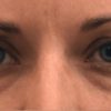 An image of a woman's eyes before and after a blepharoplasty.