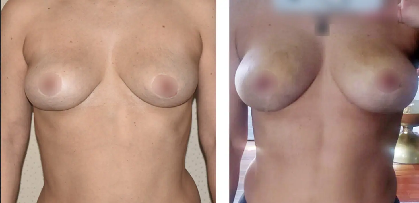 A woman's breast before and after Fat Transfer surgery.