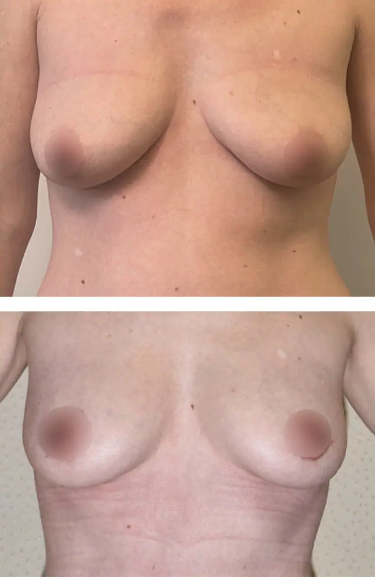 A woman's breast before and after Fat Transfer Augmentation surgery.