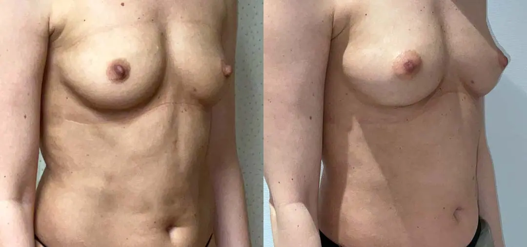A woman's breast before undergoing Fat Transfer augmentation surgery.