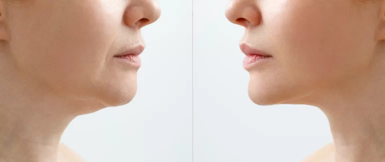 before and after chin lipo procedure