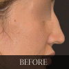 A woman's nose before and after rhinoplasty.
