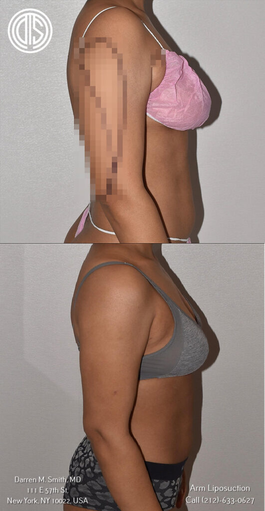 Before and after with arm liposuction