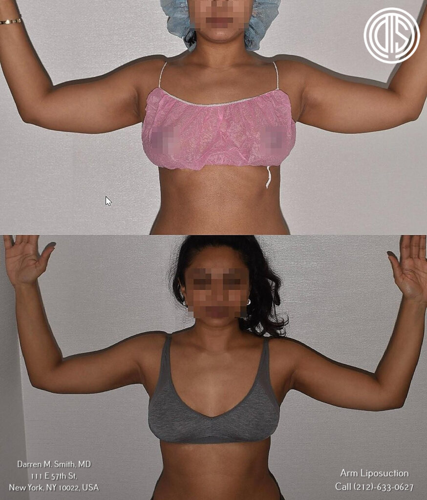 A woman's arms before and after arm liposuction procedure