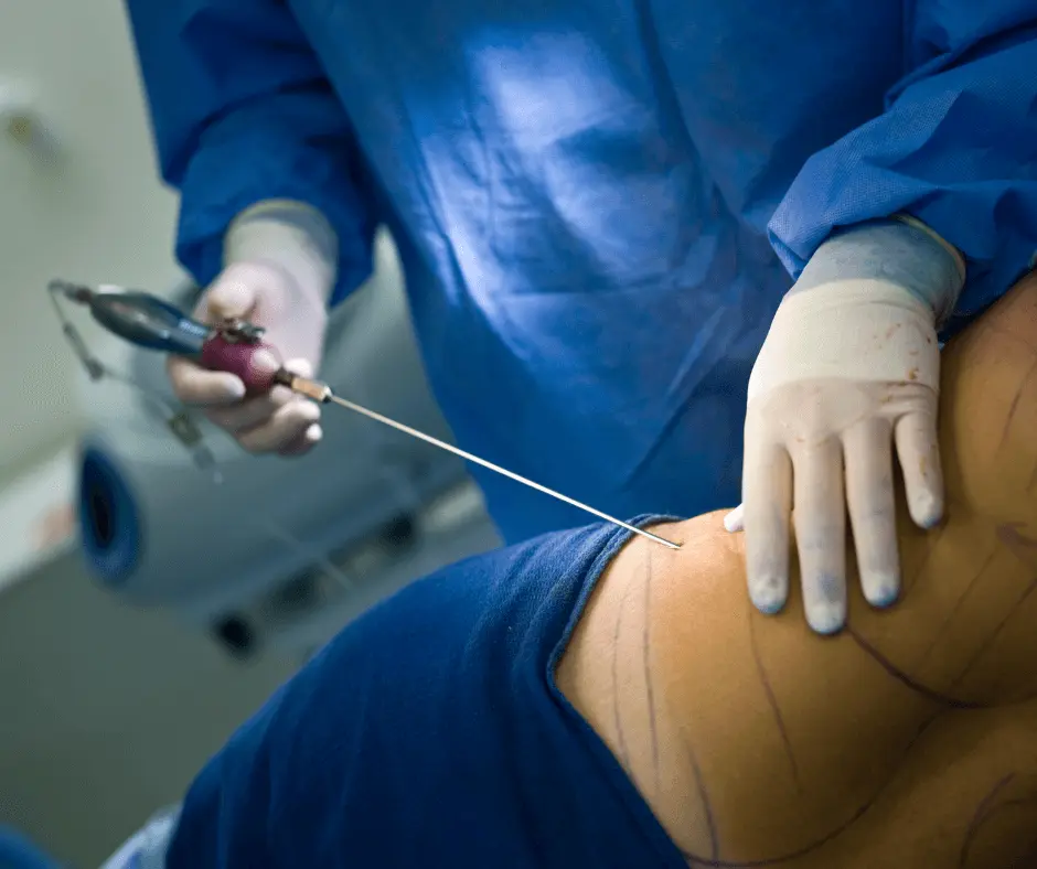A woman is undergoing abdominal surgery performed by a skilled surgeon.