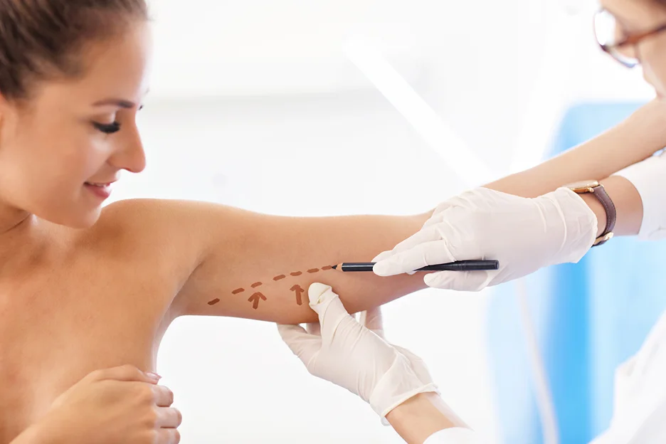A woman is getting her arm marked by a doctor, undergoing arm laser liposuction.