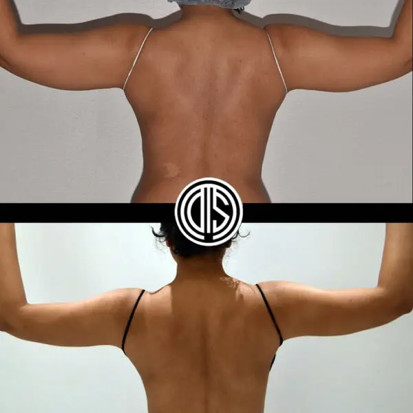 A woman's back, showing noticeable improvements in her arms after surgery.