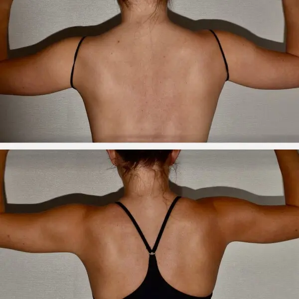 A woman's back before and after a tummy tuck, highlighting the transformation in her midsection.