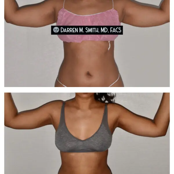 Before and after pictures of a woman's breasts and arms transformation.