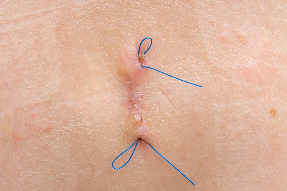 A close up of a woman's arm with precision arm lipo incisions.