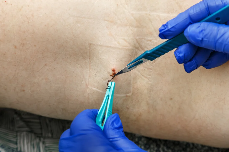 A person in blue gloves is removing threads after  arm lipo.