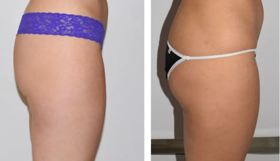 A woman's posterior before and after liposuction.