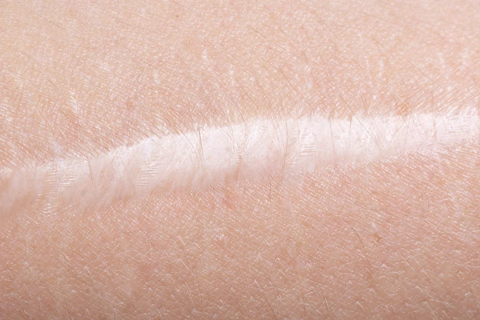 A close up of a person's arm with scar, after brachioplasty.