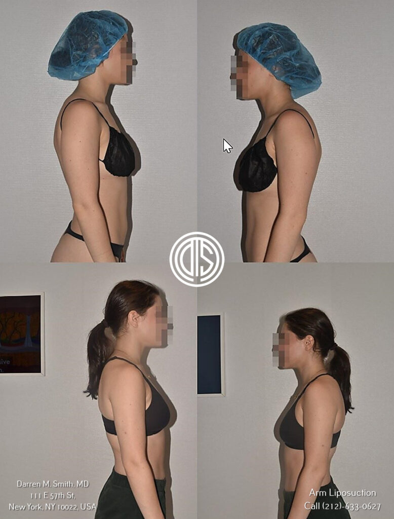 brachioplasty before and after photos showcasing successful results.